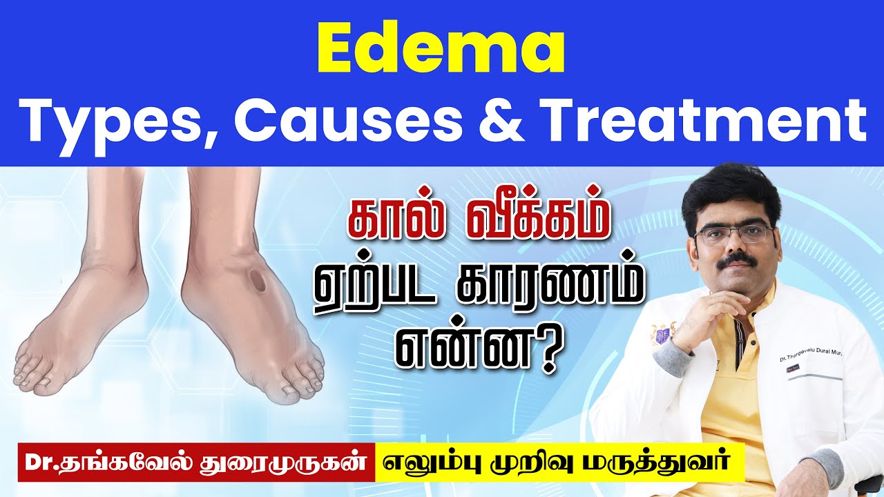 கால்வீக்கம் ஏற்பட காரணம் என்ன? Edema, Causes, Signs and Symptoms, Diagnosis and Treatment in tamil