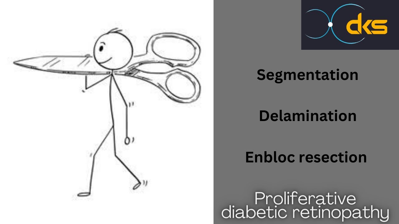 Segmentation, Delamination & Enbloc resection in PDR Vitrectomy