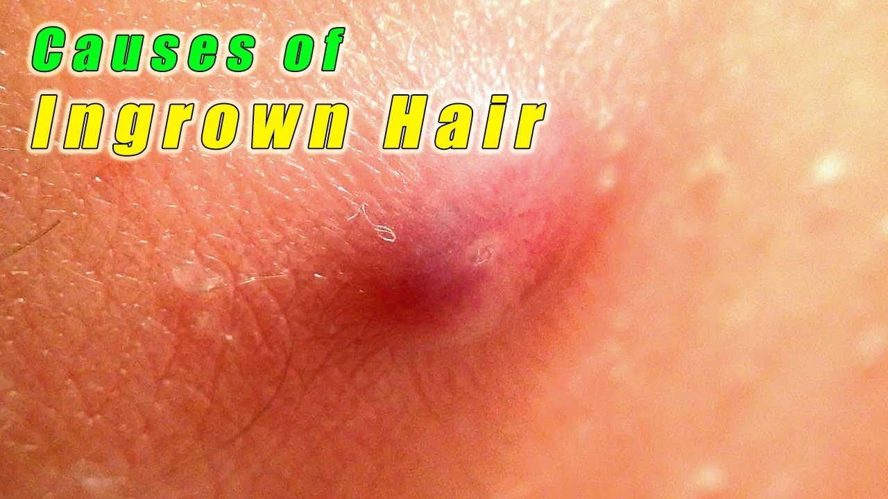 Ingrown Hair Removal 4 Best Home Remedies For Ingrown Hair Removal Youtube