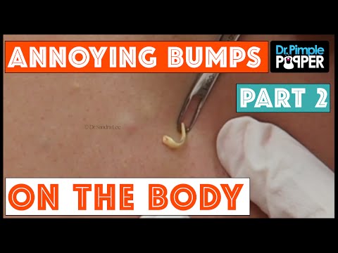 Are these BIG BLACKHEADS on her body?! Part 2, Session 1