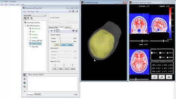Magnetic Resonance Brainstorm 3D Matlab Projects