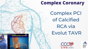Complex PCI of Calcified RCA via Evolut TAVR