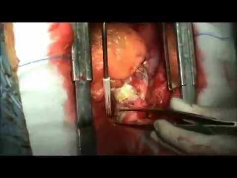 Bentall Operation Using Valsalva Conduit   Cardiac Surgery Unit UMG Catanzaro