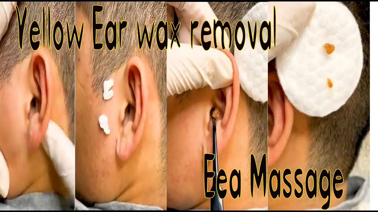 Yellow ear wax removal / Remove Ear wax and ear massage / YouTube