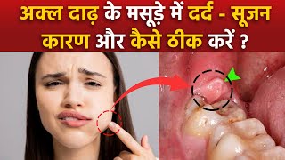 Pericoronitis Treatment At Home: Akal Daad Ke Masude Fulne Ka Ilaj |Wisdom Teeth Gum Swelling Remedy Resimi