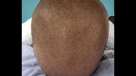 Hair Transplant Cover up 1st session SMP Scalp Micropigmentation by El Truchan