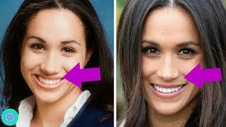 Meghan Markle Transformation, Weight Loss  and Plastic Surgery