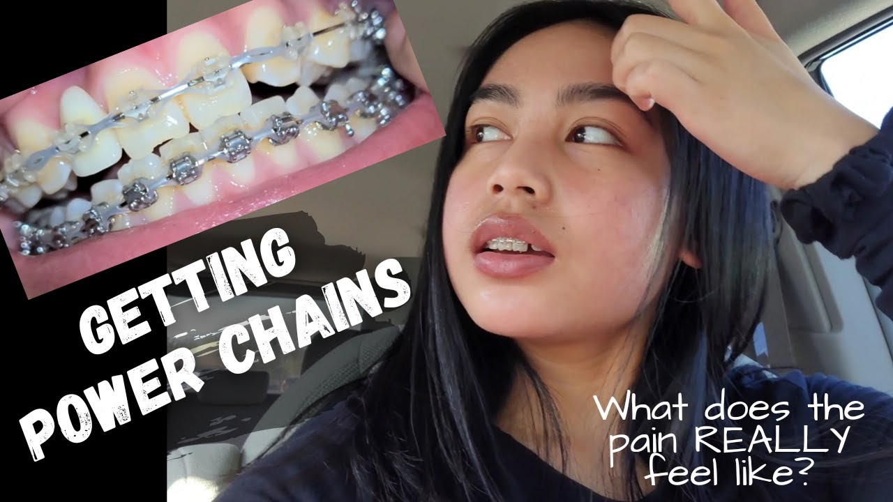 4month BRACES update (What does the pain REALLY feel like?) Power