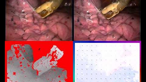 Surgical Vision: Stereoscopic Scene Flow