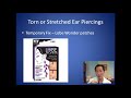 How Can I Fix My Torn or Stretched Out Ear Piercing - Earlobe Repair Consultation - Dr. Anthony Youn