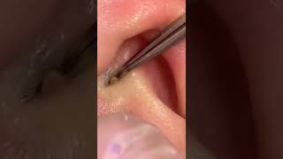 Ear Blackhead Extraction #shorts