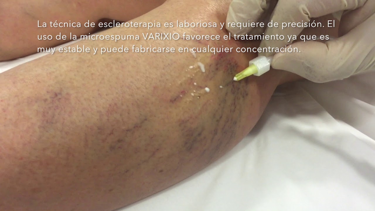 Tratamentul cu un laser în astrakhan varicoz - gyros-thessalonikis.ro