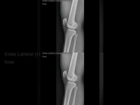         تصوير الركبه ممتدة اشعة سينية