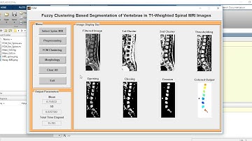 MATLAB code of Segmentation of Spinal cord MRI Image using FCM Clustering