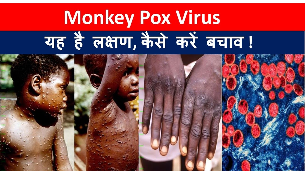 Monkeypox Box Monkey Pox Virus यह है लक्षण, कैसे करें बचाव ! Causes, Symptoms ...