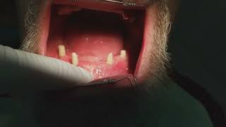 Пациент &quot;А&quot;. 3-я часть. Все на 4-х мк. мостовидный протез на имплантатах мегаджен. 4 я стоматология.