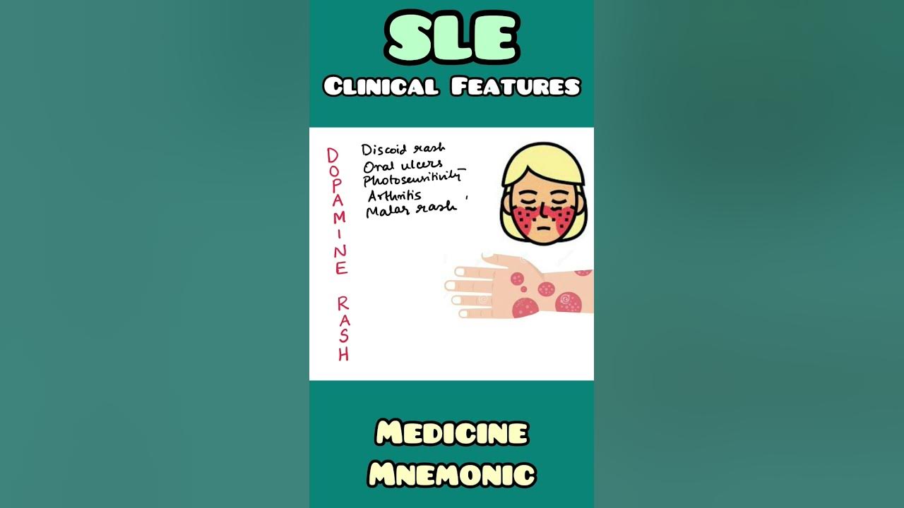 Systemic Lupus Erythematosus SLE Clinical Features Mnemonic systemic-lupus-erythematosus-sle-clinical-features-mnemonic