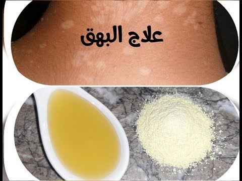 علاج البهق بوصفة سحرية سريعة وسهلة في مدة قصيرة