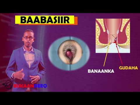 baabasiirka waxa sababa sida lagu garto iyo daawadiisa