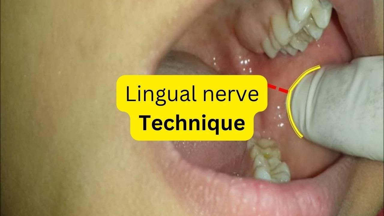 How To Give Lingual Nerve Block YouTube how-to-give-lingual-nerve-block-youtube