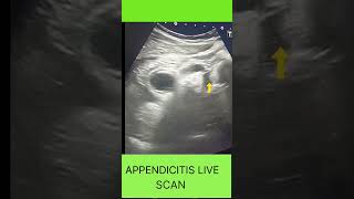 Acute Appendicitis on Ultrasound | Thick Omentum & Fluid Collection Explained LIVE