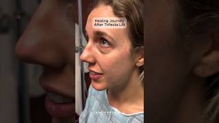 Trifecta Lift For Puffy Eyes Blepharoplasty Fat Transfer Co2 Laser