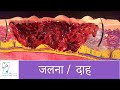 जलने और उनके उपचार पर आधारित प्रश्नोत्तरी