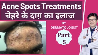 चेहरे से काले दाग धब्बे कैसे हटाये | Acne Spots Removal Treatment In Jaipur | Dermatologist