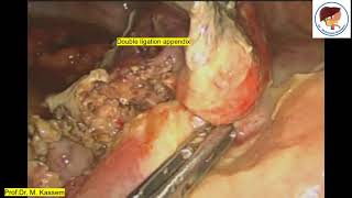 استئصال زايدة منفجرة ومرارة بالمنظار Laparoscopic appendectomy & abscess drainage + cholecystectomy