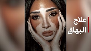 هل يمكن علاج البهاق ؟