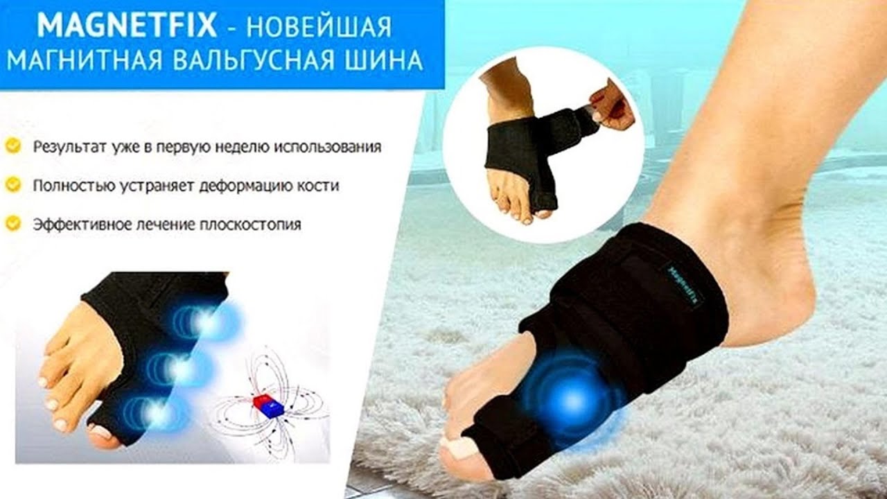 🤒 ВЫЛЕЗЛА КОСТОЧКА НА НОГЕ ВОЗЛЕ БОЛЬШОГО ПАЛЬЦА 🔵 ИЗБАВИТЬСЯ ОТ ...