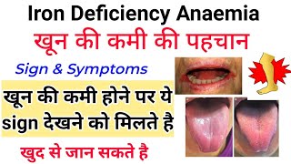 Iron deficiency Anaemia - Sign & Symptoms || खून की कमी के लक्षण