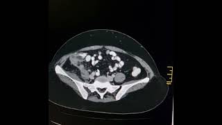 Sequele of ruptured retrocecal and retrocolic appendix.
