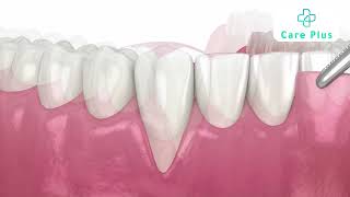 SOFT TISSUE GRAFT SURGERY screenshot 2