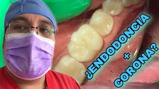 Corona LIBRE DE METAL (EMAX) POSTENDODONCIA [caries bajo amalgama] #2