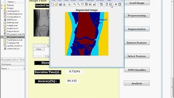 RHEUMATOID ARTHRITIS DETECTION USING IMAGE PROCESSING
