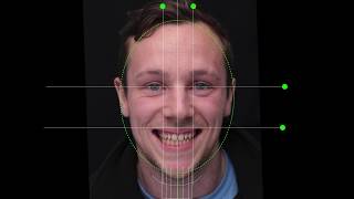 Digital smile design composite makeover