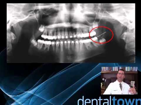 Dental CE: Triaging the Facial Pain Patient: The Non-Odontogenic Toothache