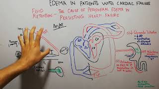CVS 221 || Pathophysiology of peripheral edema in persisting heart failure