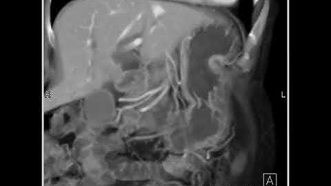 Abdomen: Pancreas: Staging of pancreatic cancer:Analysis of arterial and venous structures(1 of 11)