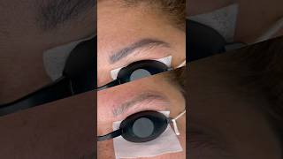 Laser tattoo removal process