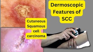 Dermoscopic Features Of Sccsquamous Cell Carcinoma
