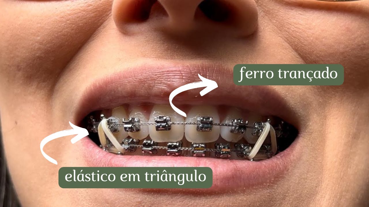 FIO DE AÇO TRANÇADO UM ANO DE APARELHO ORTODÔNTICO AUTOLIGADO