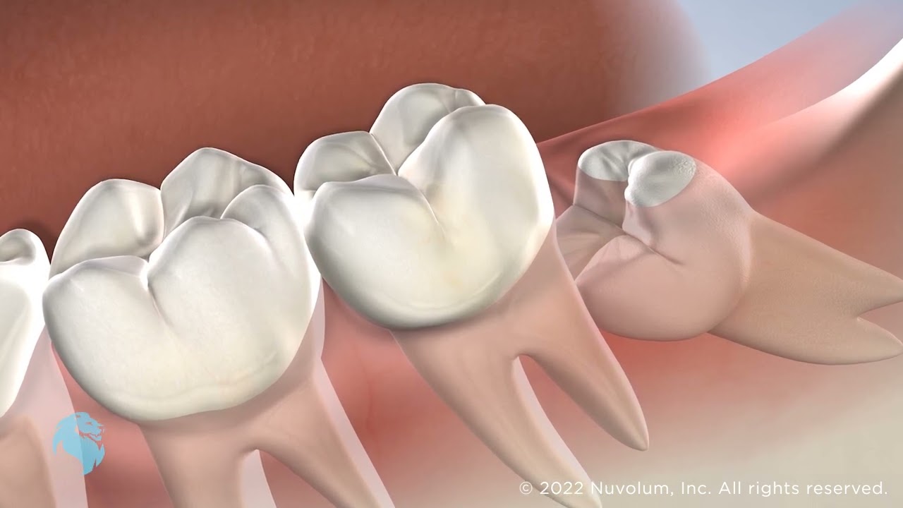 Wisdom Teeth Removal in New Hudson, MI