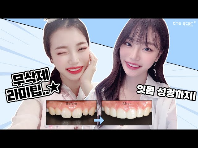 [더스타치과]잇몸교정과 무삭제 라미팁의 콜라보🥰