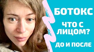 Ботокс: побочки, криворукий врач, до и после