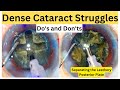 Dense cataract struggles separating the leathery posterior plate dos and donts dr deepak megur