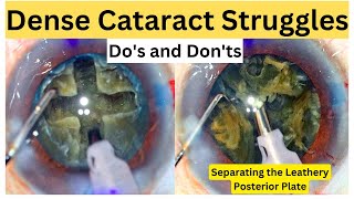 Dense Cataract Struggles Separating The Leathery Posterior Plate Dos And Donts -Dr Deepak Megur