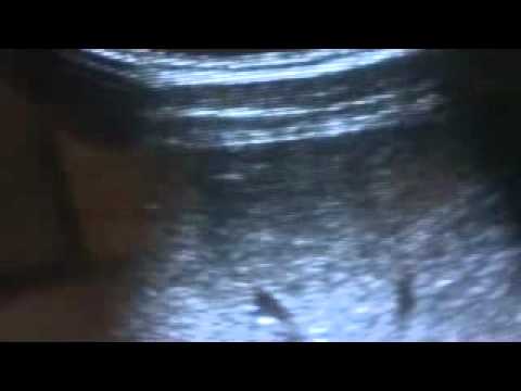 ultrasound of NORMAL LIVER part 2 of 3 - YouTube