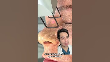 Láser CO2 fraccionado #laser #co2 #cicatriz #arrugas